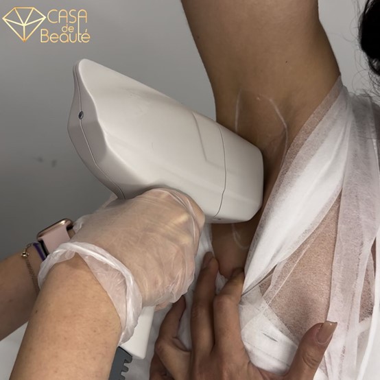 Αποτρίχωση με laser μασχάλη