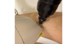 Oδηγίες πριν τη συνεδρία Laser αποτρίχωση